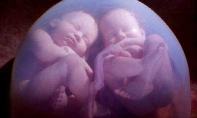 Επιστημονικό παράδοξο: Έμεινε έγκυος ενώ ήταν ήδη έγκυος