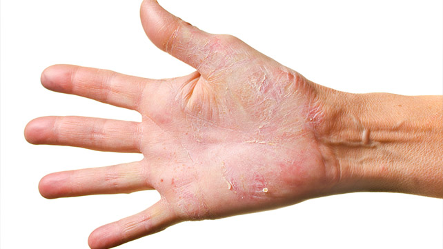 Φάρμακο βελτιώνει την ψωρίαση ονύχων και παλαμών-πελμάτων