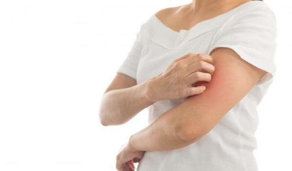 Νέες κατευθυντήριες οδηγίες για τη χρόνια κνίδωση