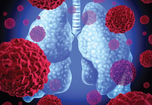 Νέα θεραπεία βελτιώνει την επιβίωση στον καρκίνο πνεύμονα
