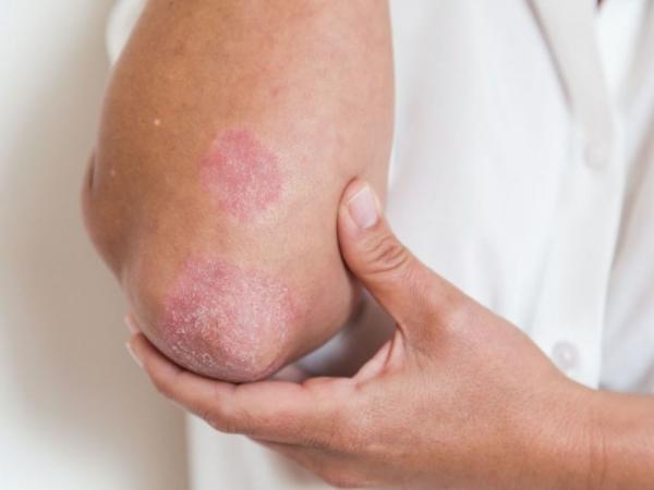 Η μεσογειακή διατροφή αμβλύνει τα συμπτώματα της ψωρίασης