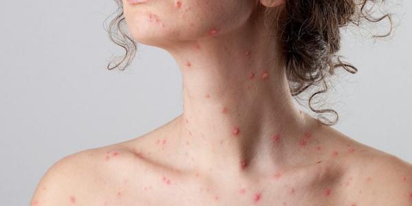 Τα 2.500 έφτασαν τα κρούσματα της ιλαράς