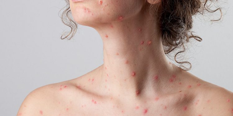 Τα 2.500 έφτασαν τα κρούσματα της ιλαράς