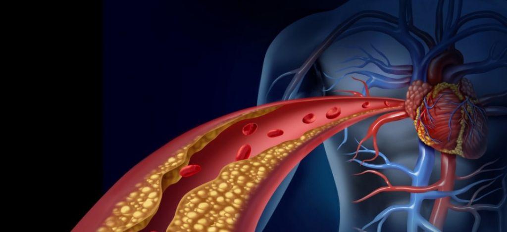 Η αθηροσκλήρωση αυξάνει τον κίνδυνο εκδήλωσης άνοιας
