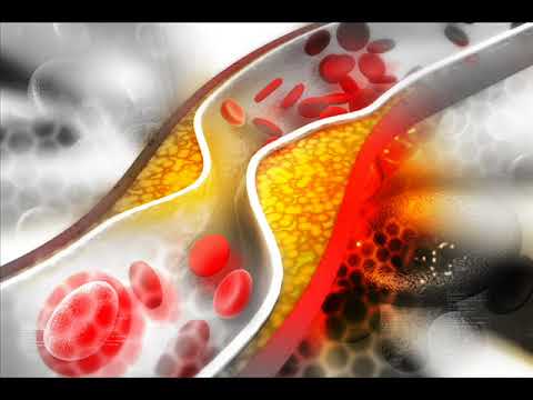 Νέα θεραπευτική επιλογή για ασθενείς με εγκατεστημένη αθηροσκληρωτική καρδιαγγειακή νόσο