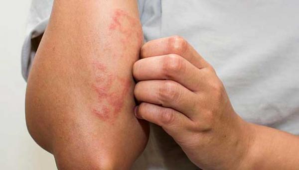 Κίνδυνος καρδιαγγειακών προβλημάτων λόγω σοβαρού εκζέματος