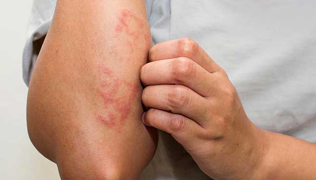 Κίνδυνος καρδιαγγειακών προβλημάτων λόγω σοβαρού εκζέματος