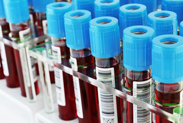 Καρκίνος Πνεύμονα: Καινοτόμο τεστ αίματος για πρώιμη ανίχνευση