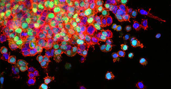 Ανακαλύφθηκαν γονίδια υπεύθυνα για τη μετάσταση του καρκίνου