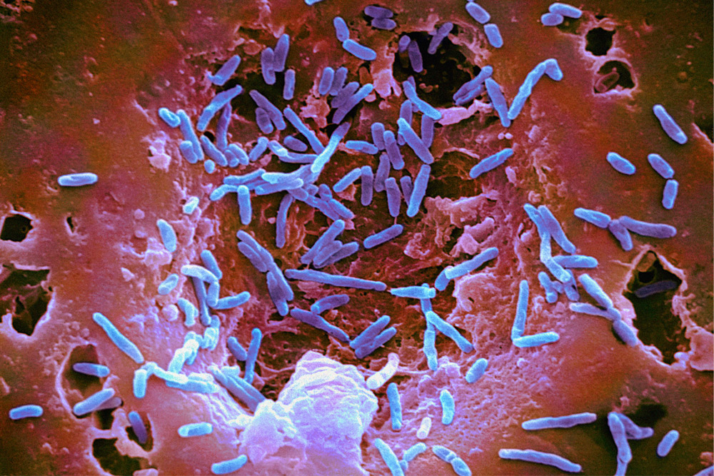 Βακτηριακή ανισορροπία ίσως πυροδοτεί τον καρκίνο τραχήλου μήτρας
