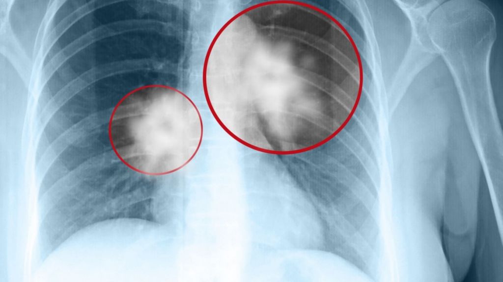 Θεραπεία βελτιώνει την επιβίωση ασθενών με καρκίνο πνεύμονα