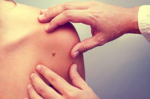 Ελπιδοφόρες εξελίξεις για τους ασθενείς με προχωρημένο πλακώδες καρκίνωμα δέρματος