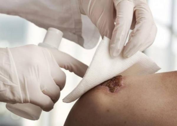 Eπίδεσμος επουλώνει ταχύτερα τα διαβητικά τραύματα