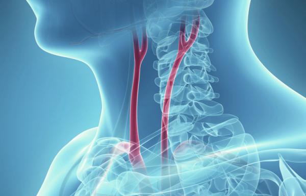 Ευρωπαϊκό πρόγραμμα για τη καρωτιδική νόσο με ελληνική συμμετοχή