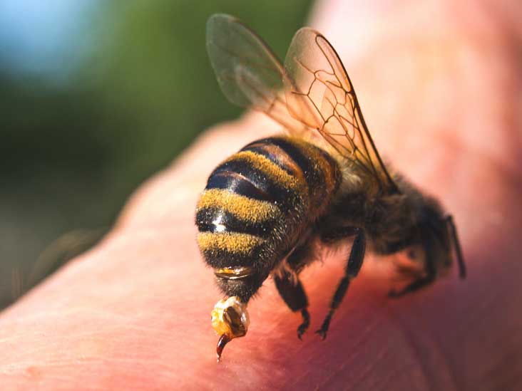 Το τσίμπημα της μέλισσας «θεραπεία» για το έκζεμα