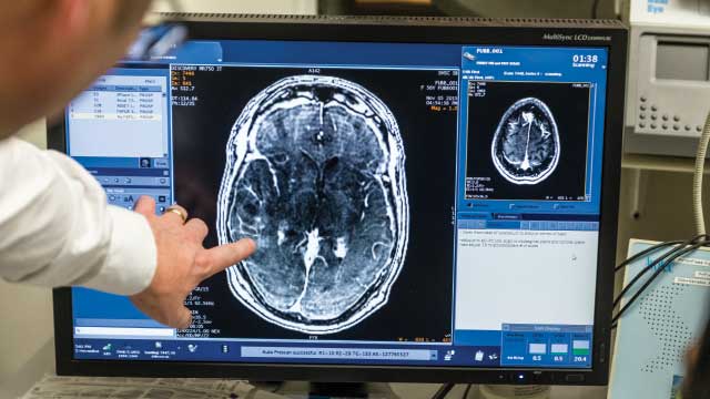 Νέα μέθοδος προσφέρει καλύτερη διείσδυση των αντικαρκινικών φαρμάκων στον εγκέφαλο