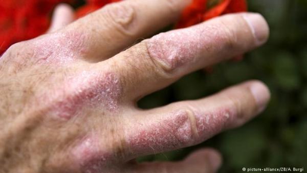 Παγκόσμια Hμέρα Ψωρίασης