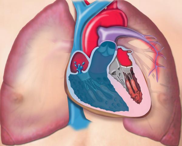 Θεραπεία επιφέρει βελτίωση στην Πυλαιοπνευμονική Υπέρταση
