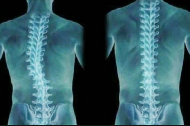 Ιχνοστοιχείο φαίνεται να παίζει ρόλο στη σκολίωση