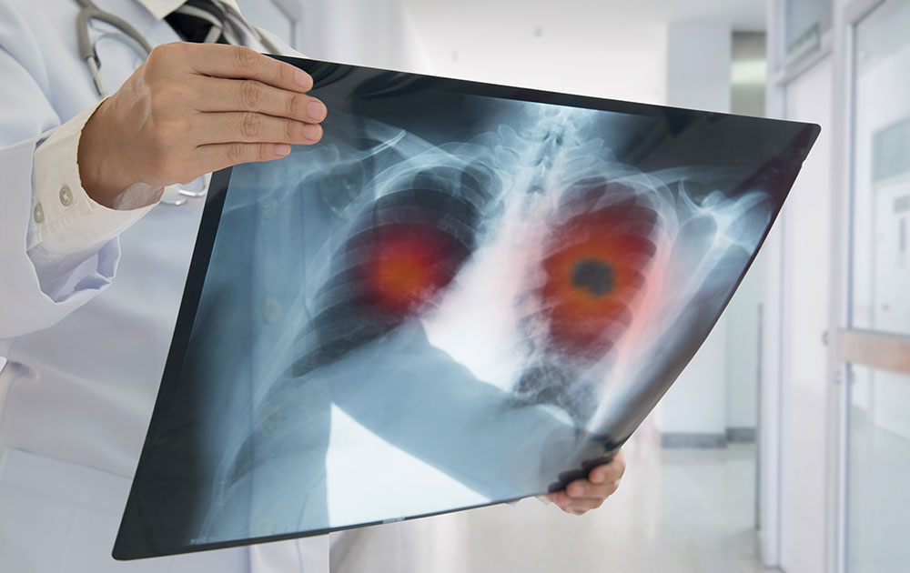 Όσα πρέπει να ξέρουμε για τον Καρκίνο του πνεύμονα
