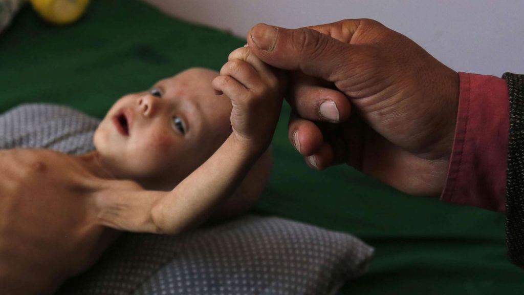 Υεμένη: 85.000 παιδιά κάτω των 5 ετών πέθαναν από ασιτία