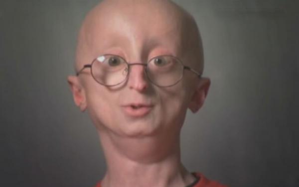 Πέθανε ο έφηβος υπερήλικος Σαμ Μπερνς