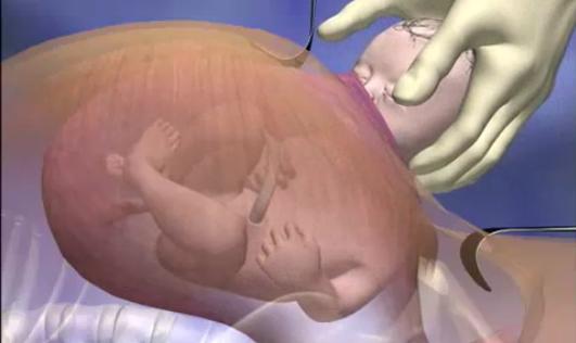 Καισαρική τομή