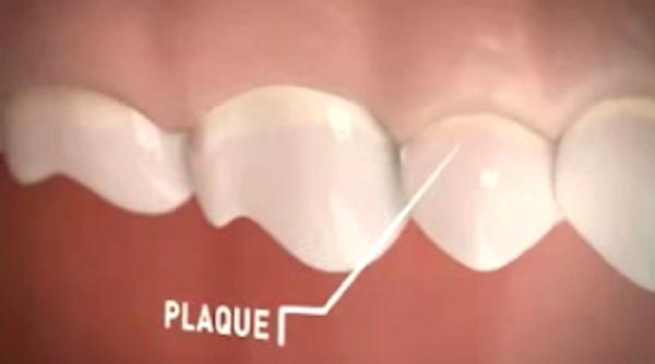 Μικροβιακή Πλάκα και Στοματική Υγεία