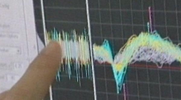 Εγκεφαλικό εμφύτευμα για παράλυτους προσφέρει ρομποτική χείρα βοηθείας