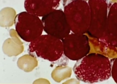 Πειραματική ανοσοθεραπεία οδηγεί σε ύφεση την οξεία λευχαιμία