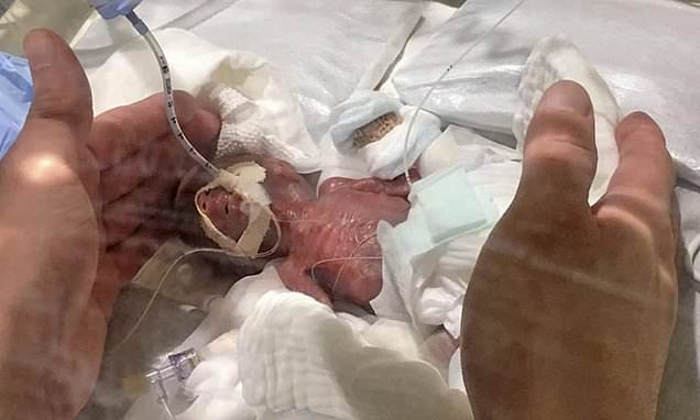 Συγκλονιστικό: Τα κατάφερε το μικρότερο μωρό στον κόσμο - Ζύγισε 268 γραμμάρια