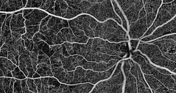 Αλτσχάιμερ: Ελπίδες για διάγνωση της νόσου μέσω οφθαλμολογικής εξέτασης