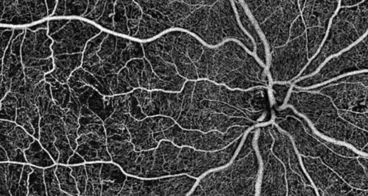 Αλτσχάιμερ: Ελπίδες για διάγνωση της νόσου μέσω οφθαλμολογικής εξέτασης