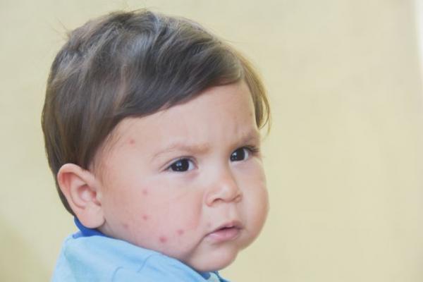 ΠΟΥ: Αυξήθηκαν κατά 300% τα κρούσματα ιλαράς