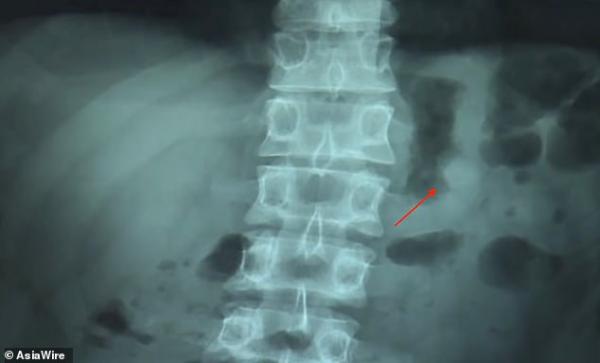 Κατάπιε τα ασύρματα ακουστικά του αλλά συνέχισαν να λειτουργούν