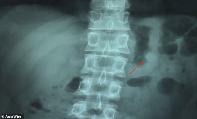 Κατάπιε τα ασύρματα ακουστικά του αλλά συνέχισαν να λειτουργούν