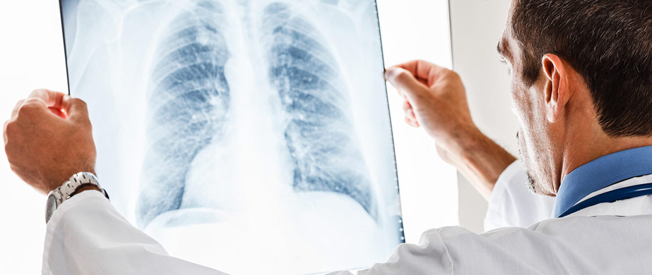 Νέο σύστημα τεχνητής νοημοσύνης ανιχνεύει τον καρκίνο του πνεύμονα καλύτερα από τους ακτινολόγους