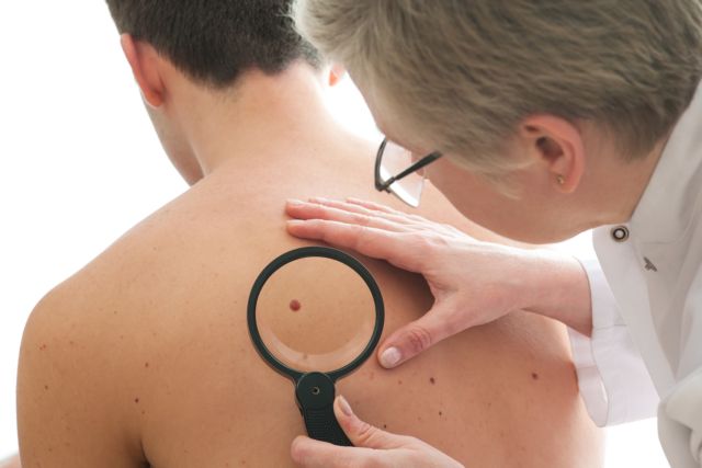 ΠΟΥ: Αυξημένα τα κρούσματα καρκίνου του δέρματος