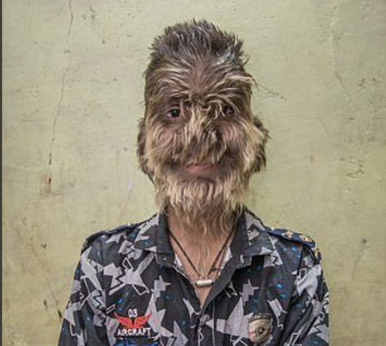 Ισπανία: Τουλάχιστον 17 παιδιά με το σύνδρομο του… λυκανθρώπου