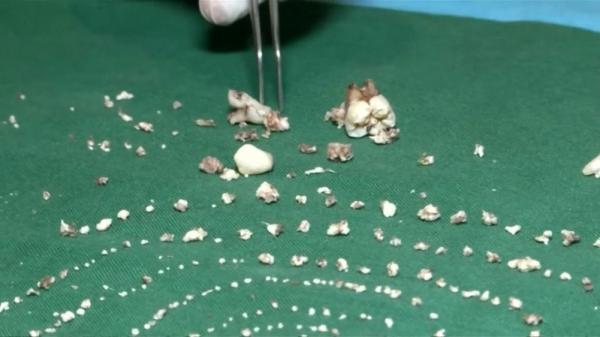 Απίστευτο: Γιατροί αφαίρεσαν 526 δόντια από το στόμα 7χρονου