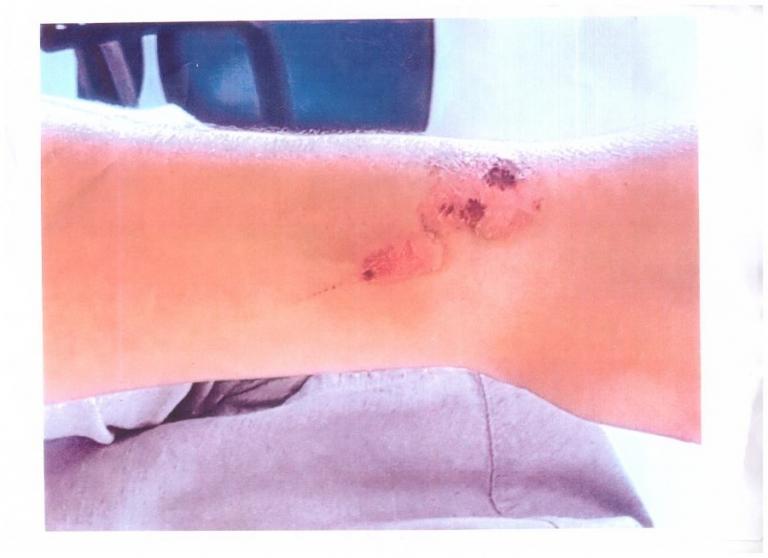 Απίστευτη καταγγελία: Βασάνιζαν με καυτό λάδι σπουδαστή μαγειρικής σε εστιατόριο