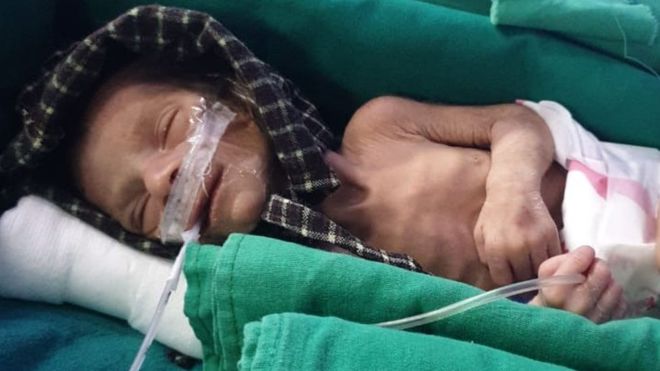 Ινδία : Ανακάλυψαν νεογέννητο κοριτσάκι που είχαν θάψει ζωντανό – Αναζητούνται οι γονείς