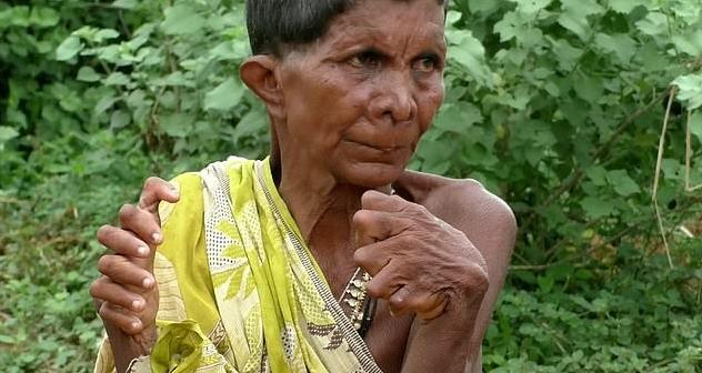 Ινδία : Γυναίκα γεννήθηκε με 12 δάχτυλα στα χέρια και 20 στα πόδια