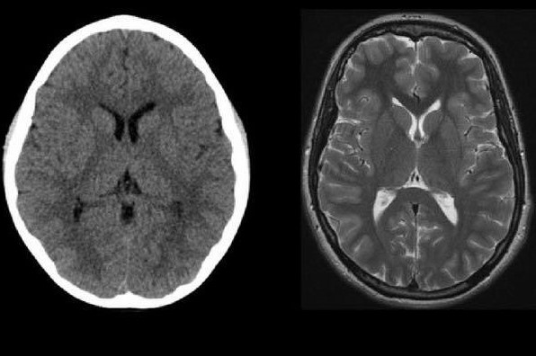 Μόλυνση: Άντρας από την Κίνα ανακάλυψε ότι έχει σκουλήκια στον εγκέφαλο