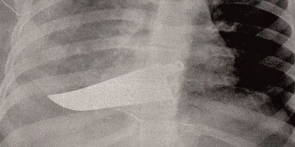 Βία κατά γυναικών: Οι ακτινογραφίες που δείχνουν τον εφιάλτη