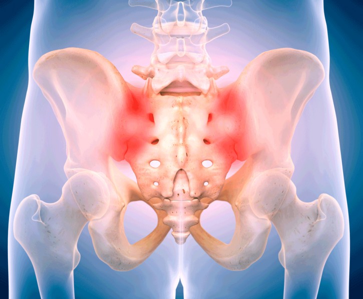 Ισχιαλγία : Πώς θα αντιμετωπίσετε τον πόνο