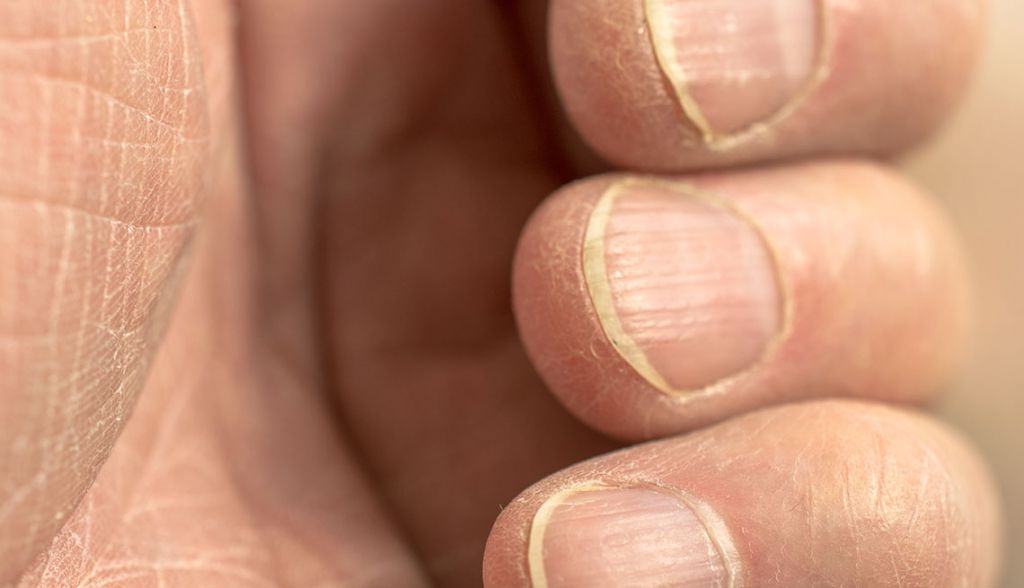 Προσοχή: Αν τα νύχια σας είναι όπως σε αυτές τις εικόνες, ίσως έχετε πρόβλημα υγείας