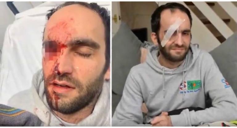 Του ήρθε το… αυγό ουρανοκατέβατο και έχασε το μάτι του