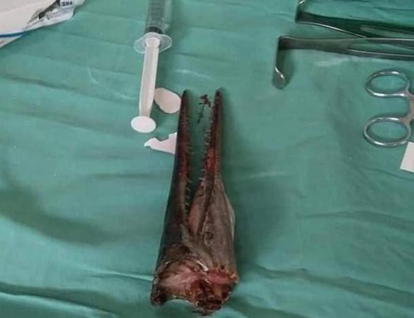 Ινδονησία : Ψάρι καρφώθηκε στο λαιμό εφήβου