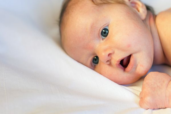 Ακμή στα μωρά: Τι είναι και πώς θα την αντιμετωπίσετε